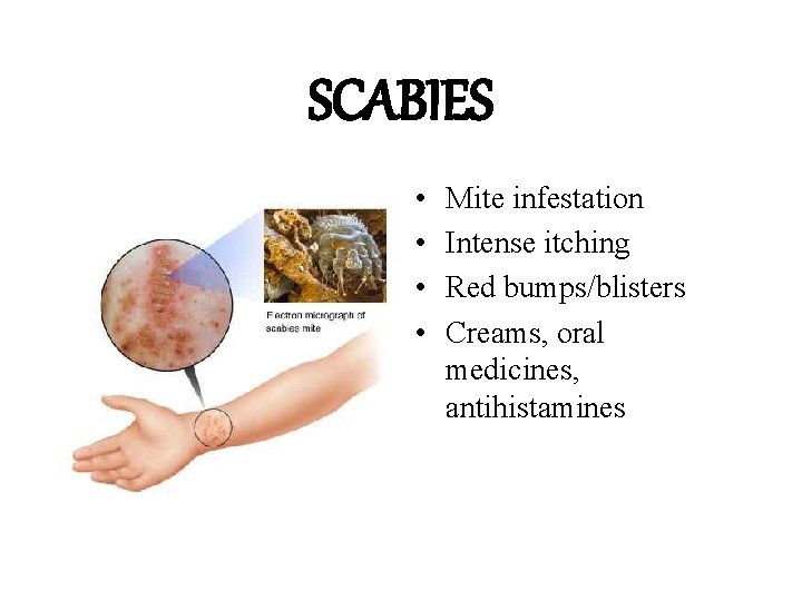 SCABIES • • Mite infestation Intense itching Red bumps/blisters Creams, oral medicines, antihistamines 