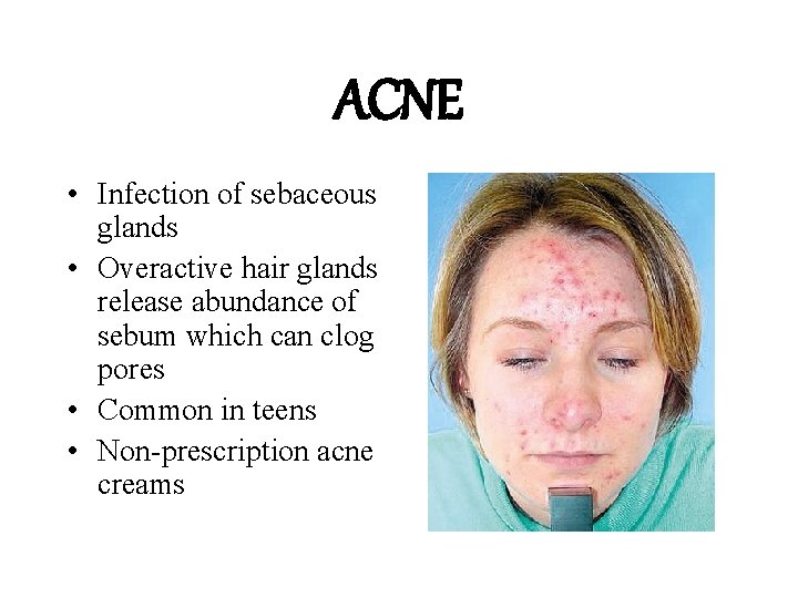 ACNE • Infection of sebaceous glands • Overactive hair glands release abundance of sebum ACNE • Infection of sebaceous glands • Overactive hair glands release abundance of sebum