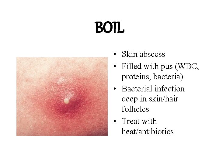 BOIL • Skin abscess • Filled with pus (WBC, proteins, bacteria) • Bacterial infection