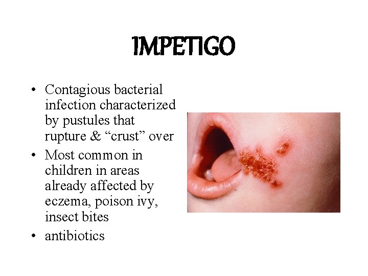 IMPETIGO • Contagious bacterial infection characterized by pustules that rupture & “crust” over • IMPETIGO • Contagious bacterial infection characterized by pustules that rupture & “crust” over •