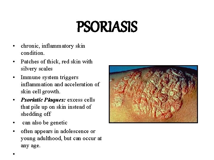 PSORIASIS • chronic, inflammatory skin condition. • Patches of thick, red skin with silvery