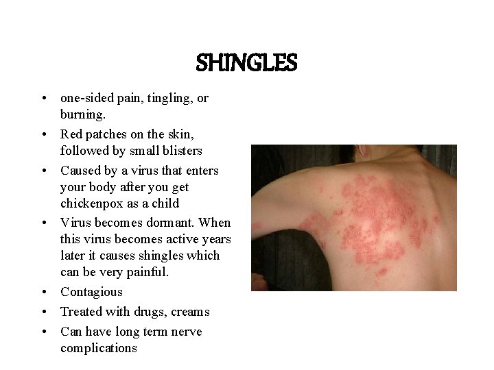 SHINGLES • one-sided pain, tingling, or burning. • Red patches on the skin, followed SHINGLES • one-sided pain, tingling, or burning. • Red patches on the skin, followed