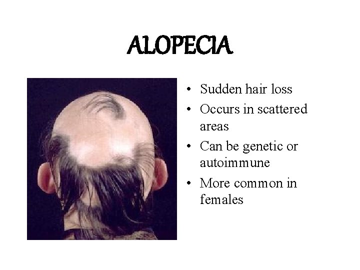 ALOPECIA • Sudden hair loss • Occurs in scattered areas • Can be genetic ALOPECIA • Sudden hair loss • Occurs in scattered areas • Can be genetic