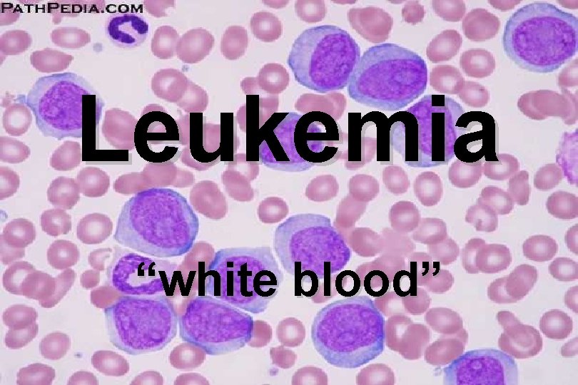 Leukemia “white blood” 
