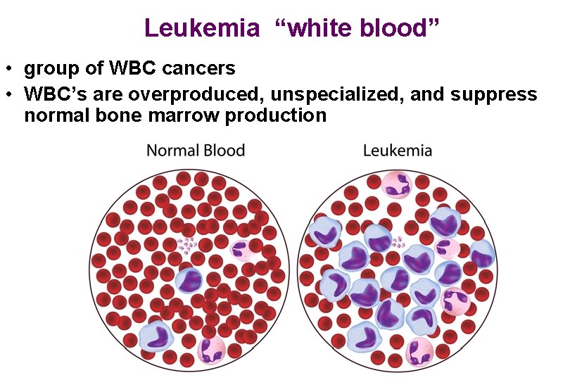 Leukemia “white blood” • group of WBC cancers • WBC’s are overproduced, unspecialized, and
