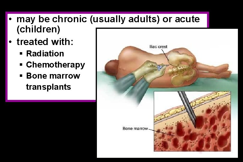  • may be chronic (usually adults) or acute (children) • treated with: §