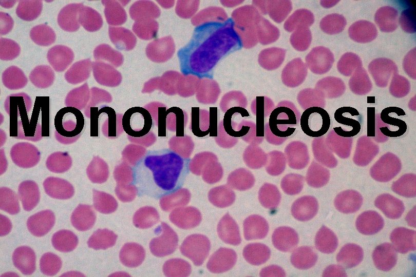 Mononucleosis 