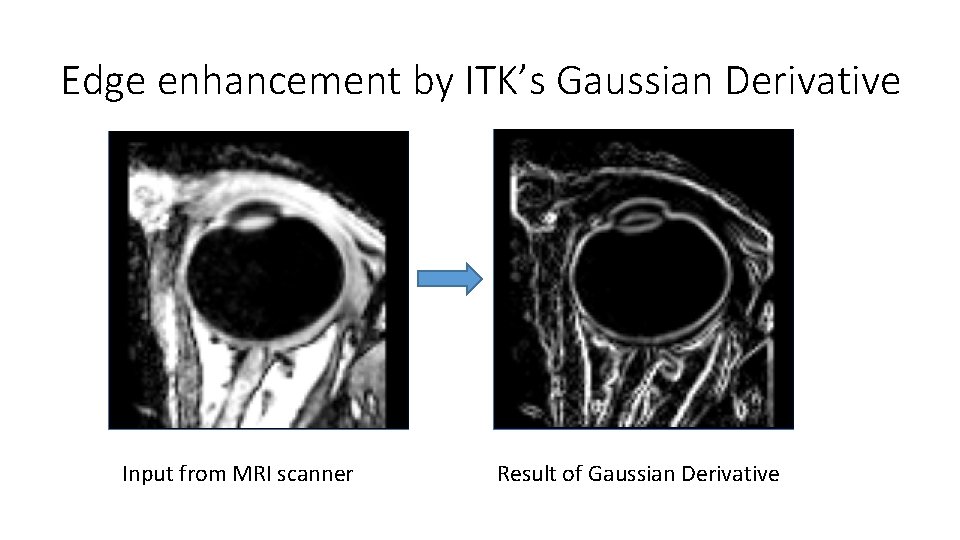 Edge enhancement by ITK’s Gaussian Derivative Input from MRI scanner Result of Gaussian Derivative