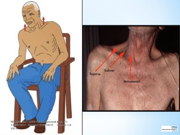 MISSION ABC: COPD Patient presentation v 1: 19/09/2017 Review 19/09/2019 Version 1. 0 2019