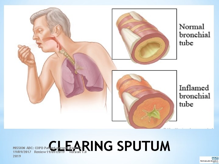 CLEARING SPUTUM MISSION ABC: COPD Patient presentation v 1: 19/09/2017 Review 19/09/2019 Version 1.