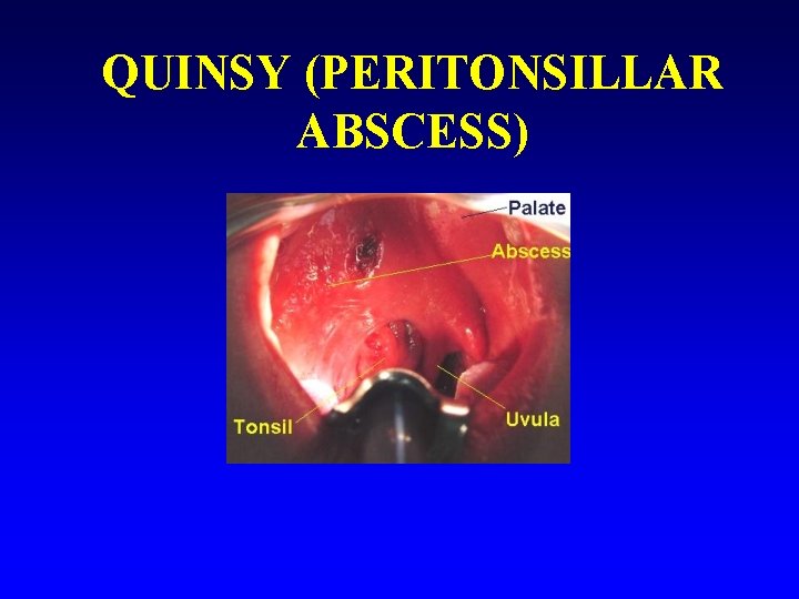 QUINSY (PERITONSILLAR ABSCESS) 