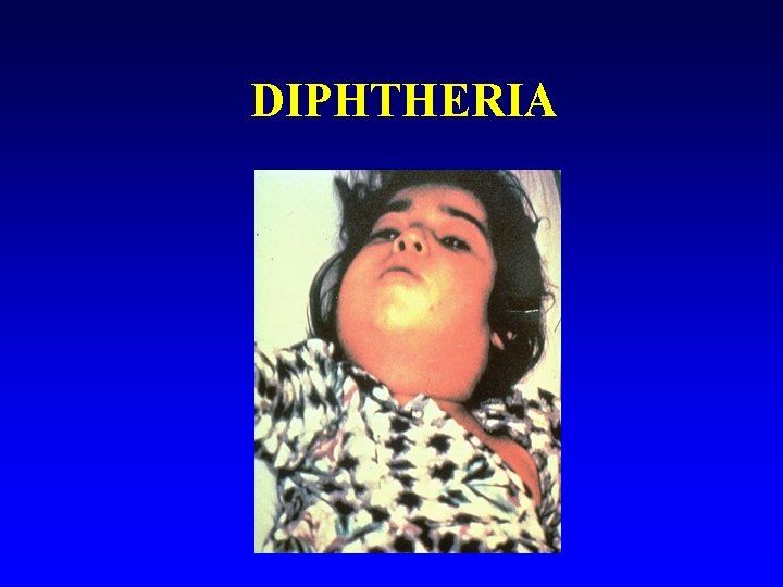 DIPHTHERIA 