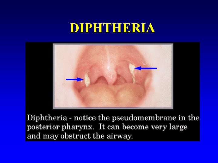 DIPHTHERIA 