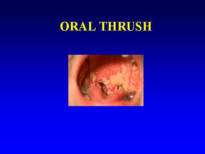 ORAL THRUSH 