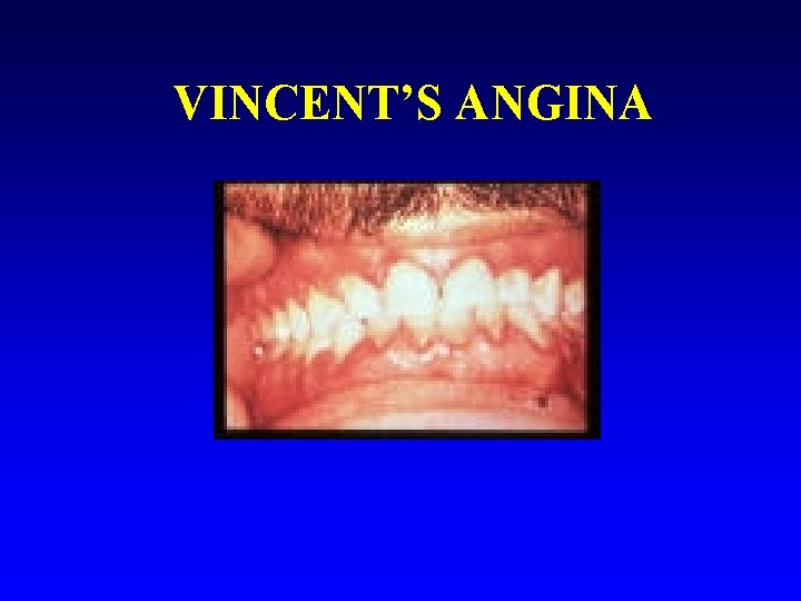 VINCENT’S ANGINA 