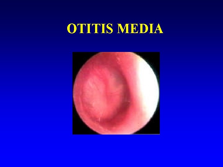 OTITIS MEDIA 