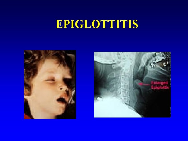 EPIGLOTTITIS 