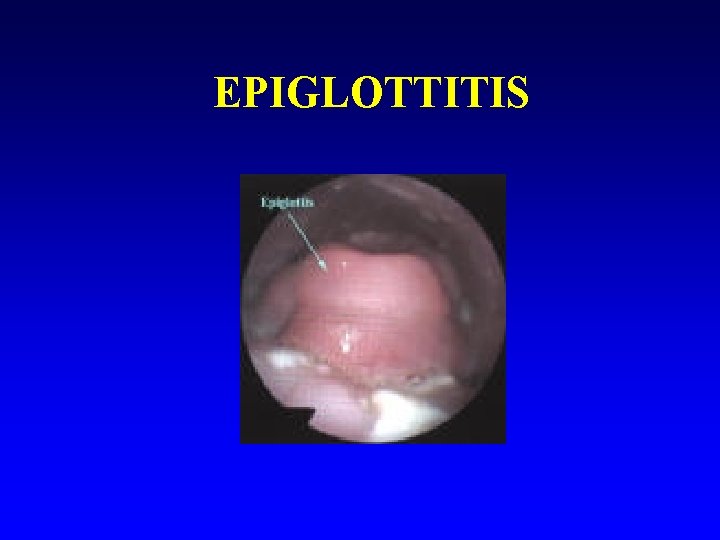 EPIGLOTTITIS 