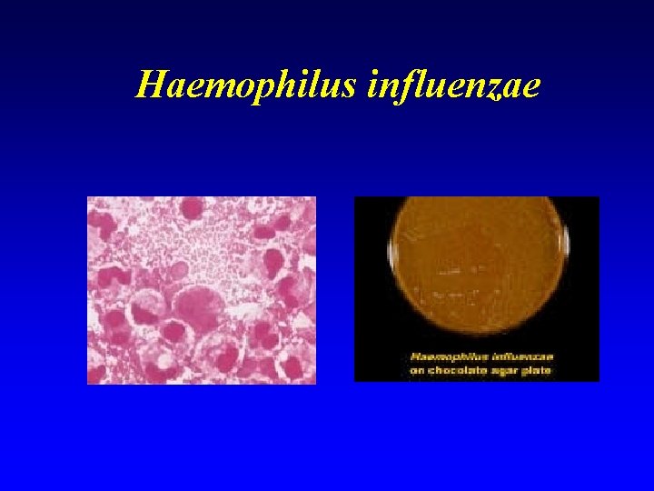Haemophilus influenzae 