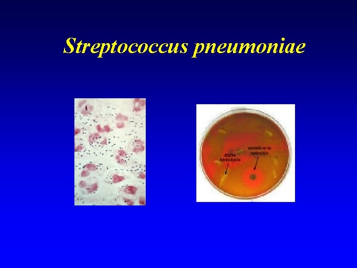 Streptococcus pneumoniae 