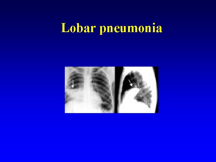 Lobar pneumonia 