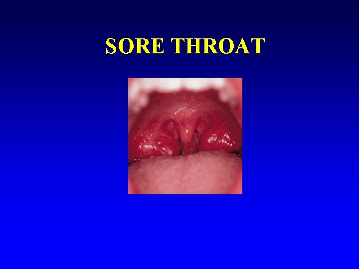SORE THROAT 