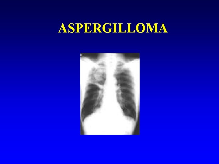ASPERGILLOMA 