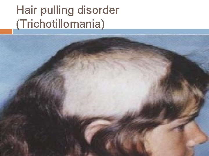 Hair pulling disorder (Trichotillomania) 