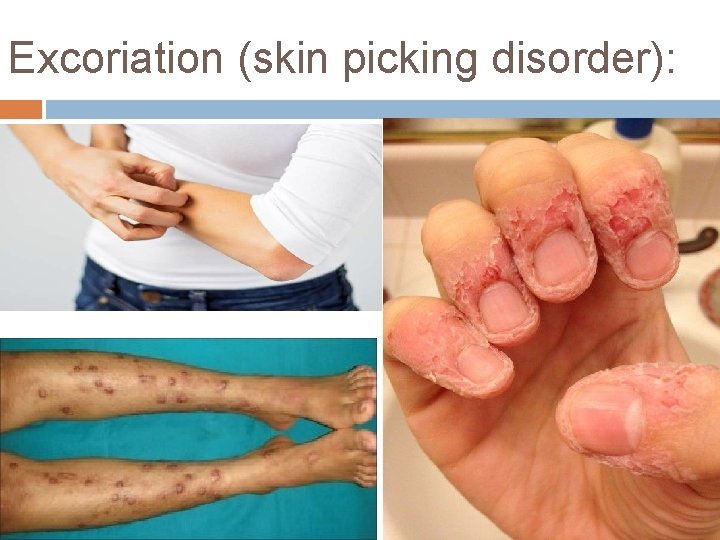Excoriation (skin picking disorder): 