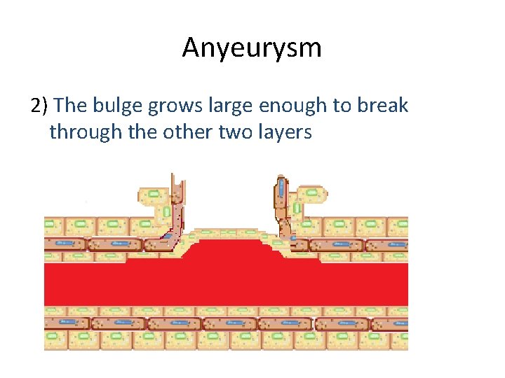 Anyeurysm 2) The bulge grows large enough to break through the other two layers