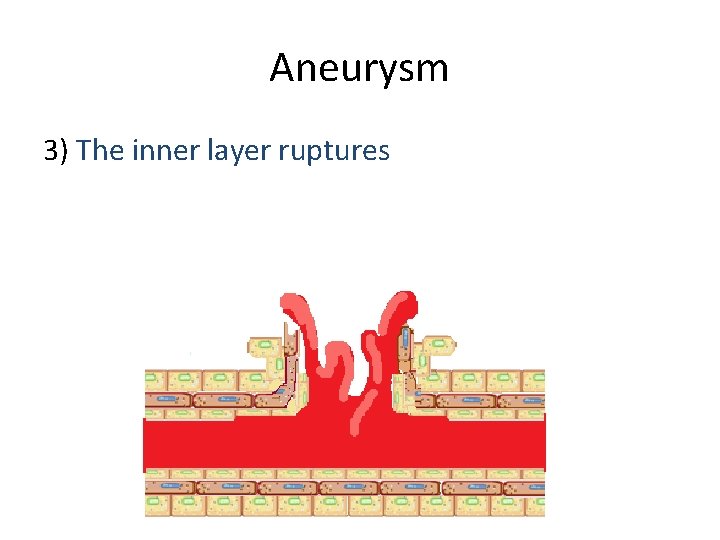 Aneurysm 3) The inner layer ruptures 