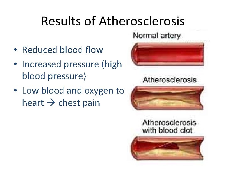 Results of Atherosclerosis • Reduced blood flow • Increased pressure (high blood pressure) •