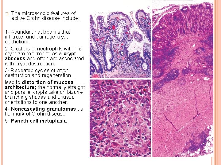 � The microscopic features of active Crohn disease include: 1 - Abundant neutrophils that
