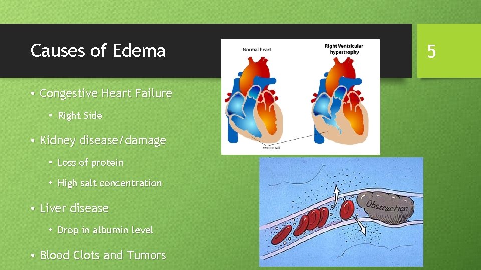 Causes of Edema • Congestive Heart Failure • Right Side • Kidney disease/damage •