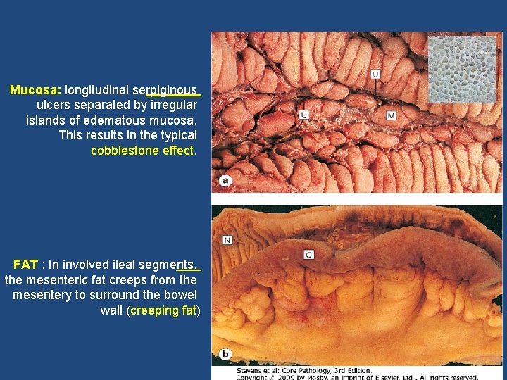 Mucosa: longitudinal serpiginous ulcers separated by irregular islands of edematous mucosa. This results in