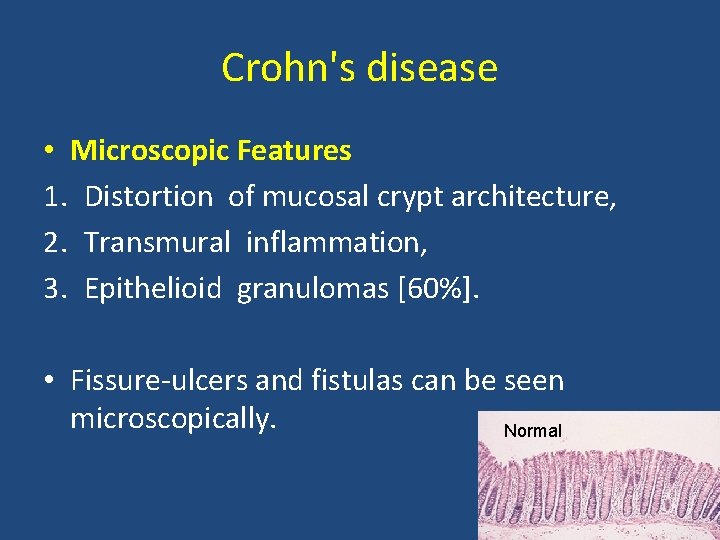 Crohn's disease • Microscopic Features 1. Distortion of mucosal crypt architecture, 2. Transmural inflammation,