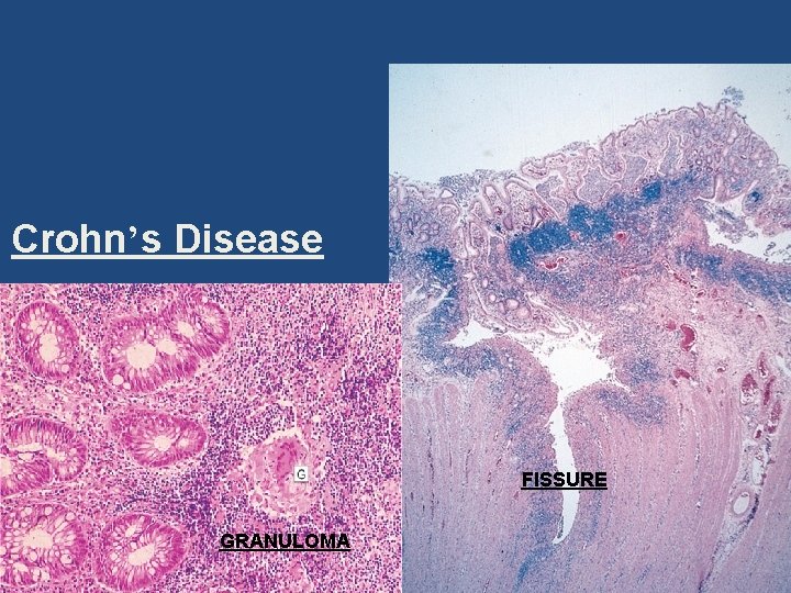Crohn’s Disease FISSURE GRANULOMA 