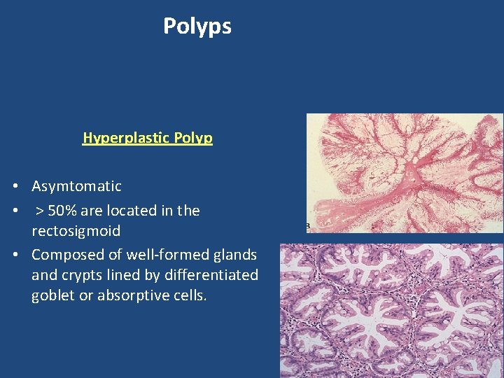 Polyps Hyperplastic Polyp • Asymtomatic • > 50% are located in the rectosigmoid •