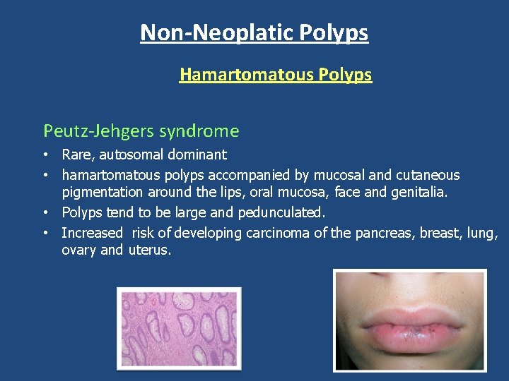 Non-Neoplatic Polyps Hamartomatous Polyps Peutz-Jehgers syndrome • Rare, autosomal dominant • hamartomatous polyps accompanied