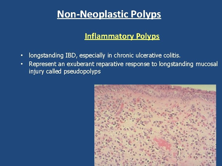 Non-Neoplastic Polyps Inflammatory Polyps • longstanding IBD, especially in chronic ulcerative colitis. • Represent