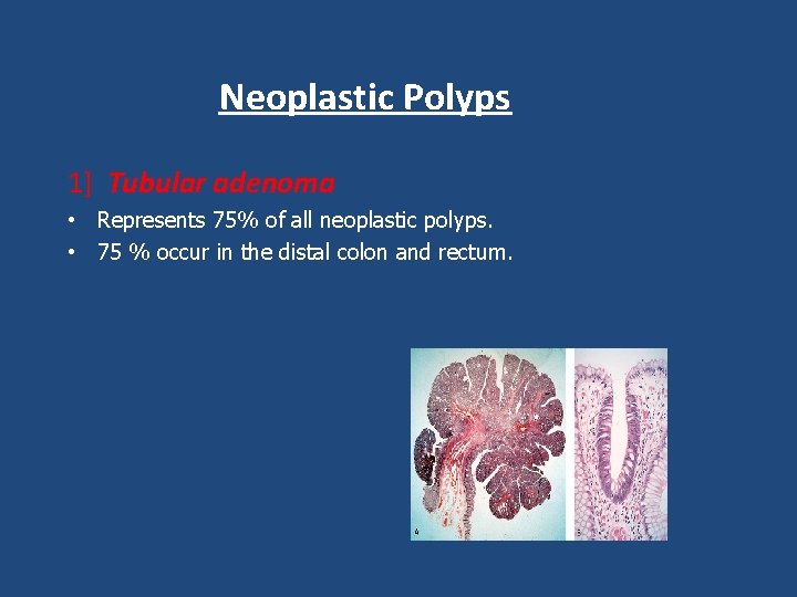 Neoplastic Polyps 1] Tubular adenoma • Represents 75% of all neoplastic polyps. • 75