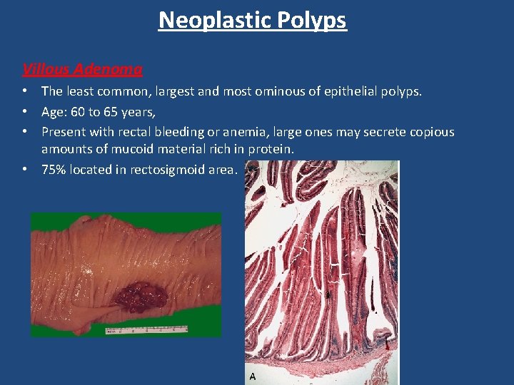 Neoplastic Polyps Villous Adenoma • The least common, largest and most ominous of epithelial