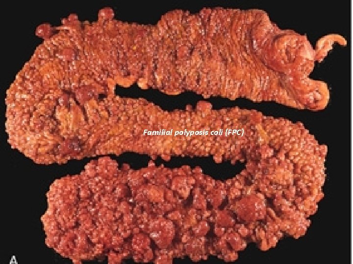 Familial polyposis coli (FPC) 
