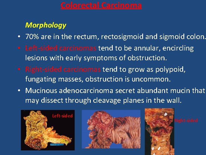 Colorectal Carcinoma • • Morphology 70% are in the rectum, rectosigmoid and sigmoid colon.