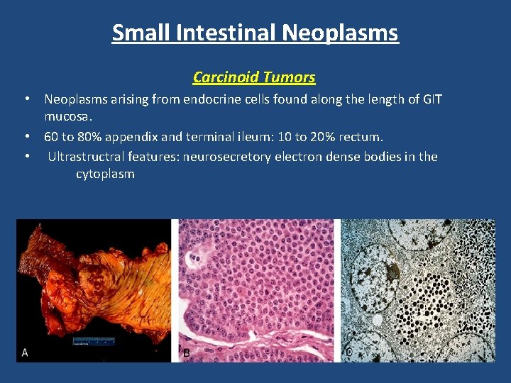 Small Intestinal Neoplasms Carcinoid Tumors • Neoplasms arising from endocrine cells found along the