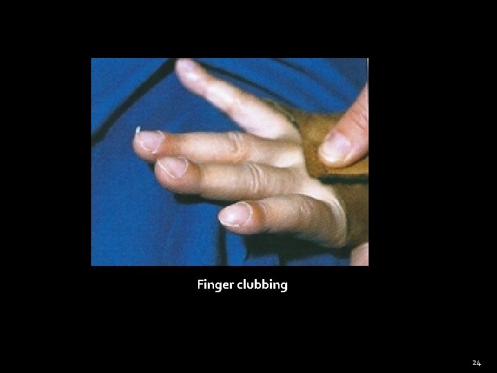Finger clubbing 24 