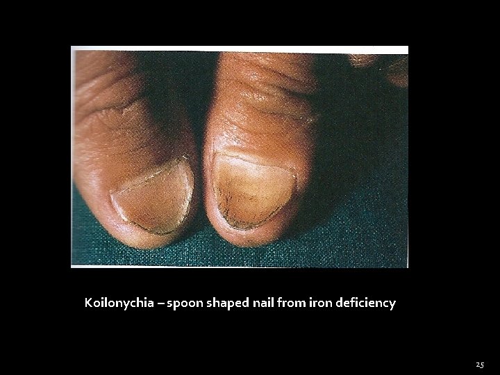 Koilonychia – spoon shaped nail from iron deficiency 25 