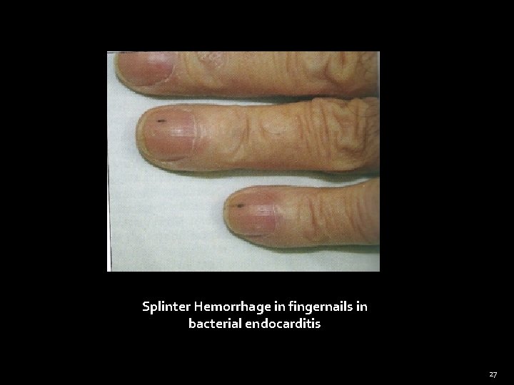 Splinter Hemorrhage in fingernails in bacterial endocarditis 27 