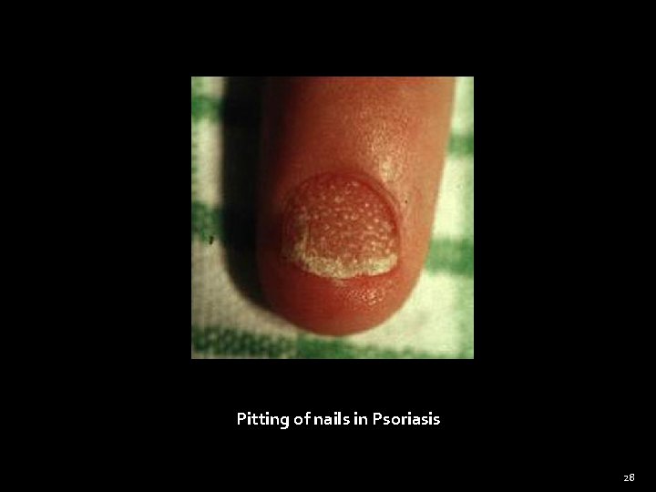 Pitting of nails in Psoriasis 28 
