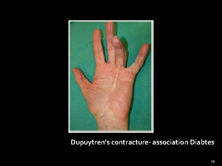 Dupuytren’s contracture- association Diabtes 29 